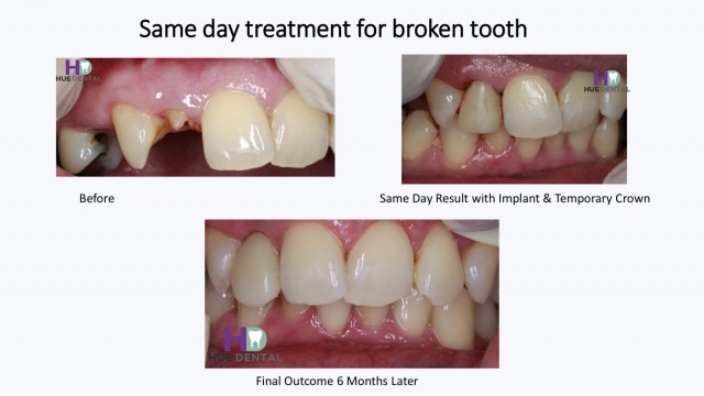 hue-implant2