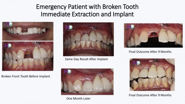 hue-implant3