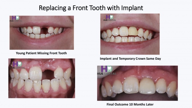 hue-implant4