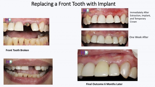 hue-implant5