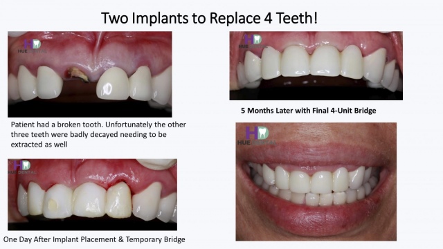 hue-implant6
