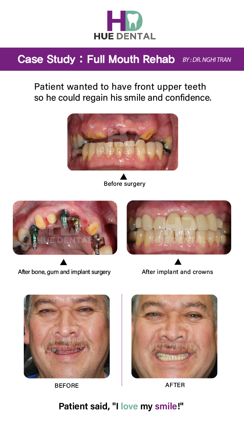 Full Mouth Reconstruction Case Study Hue Dental